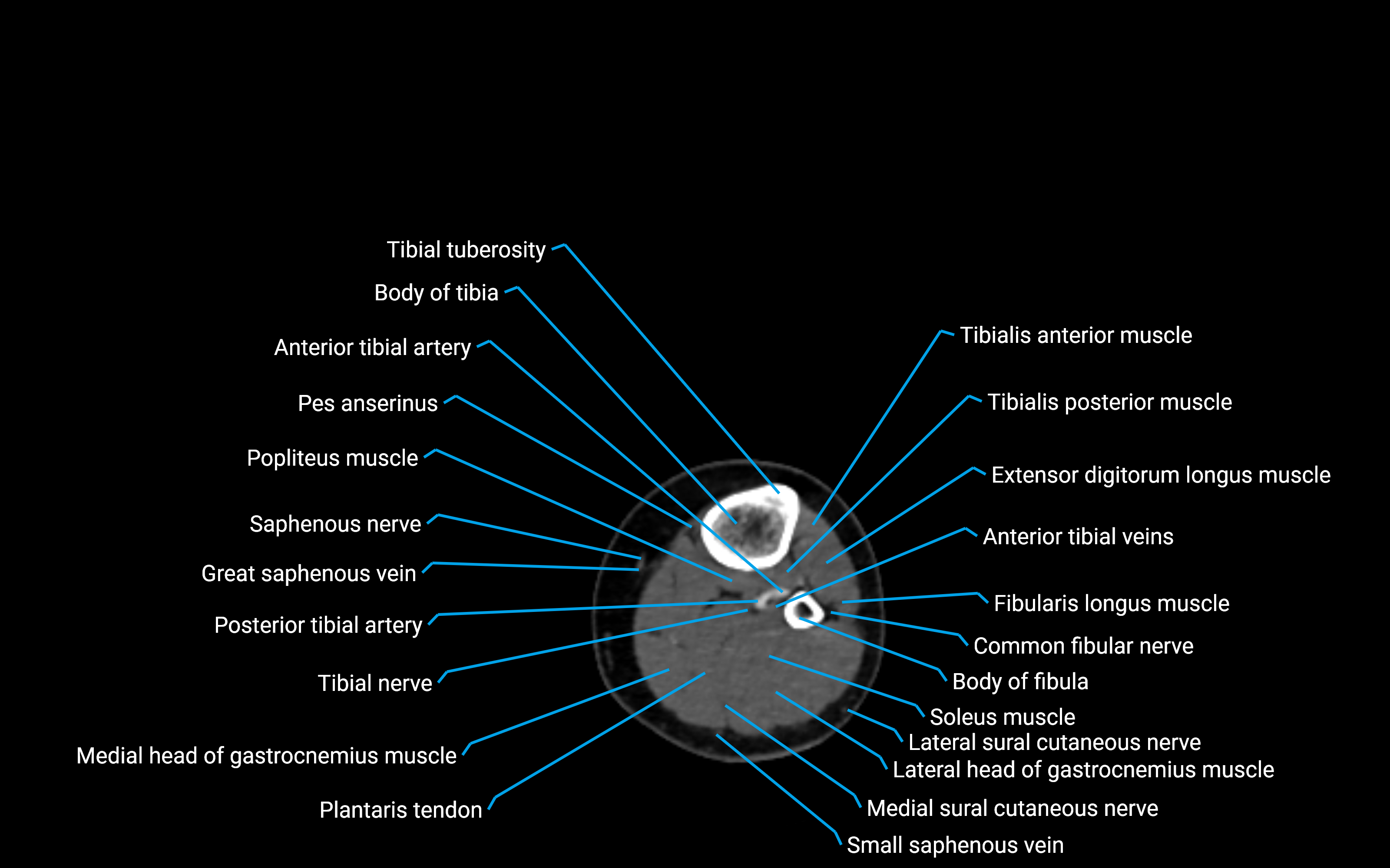CT Lower leg axial cross sectional anatomy labelled image 101 (2).png